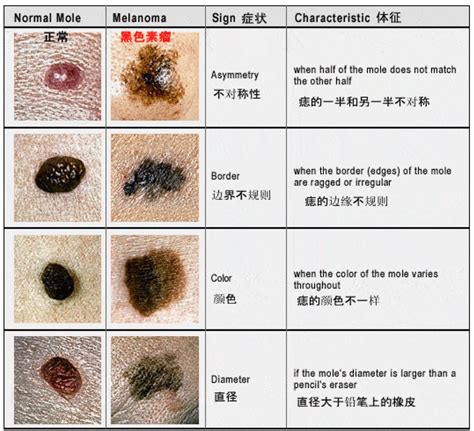 身上痣多|痣也可能会癌变！长在 3 个地方要注意